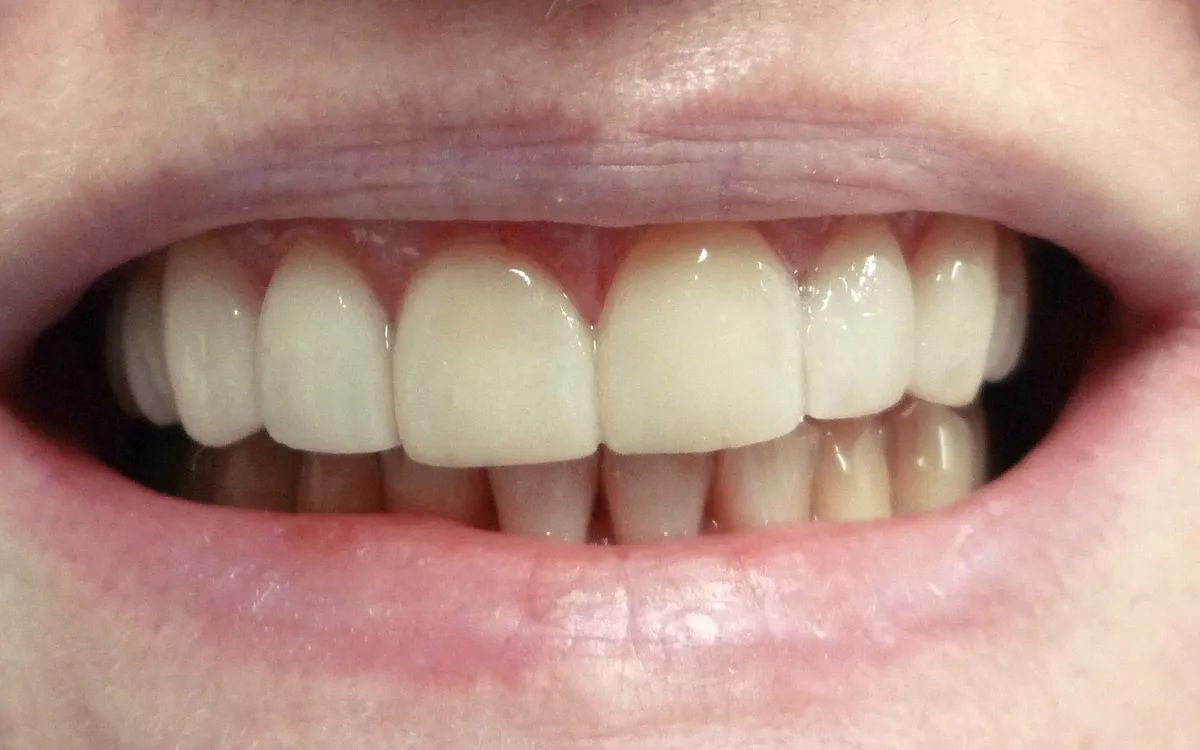 After: porcelain veneers