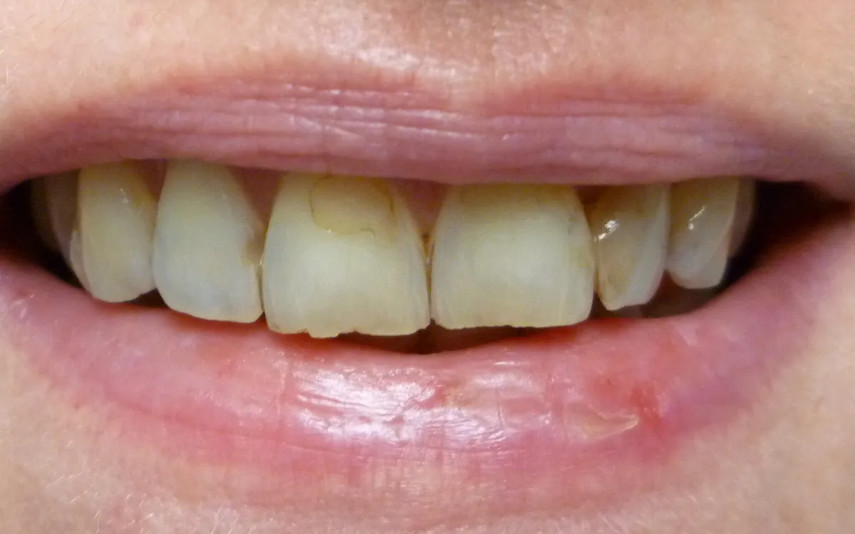 Before: worn, chipped, and stained front teeth