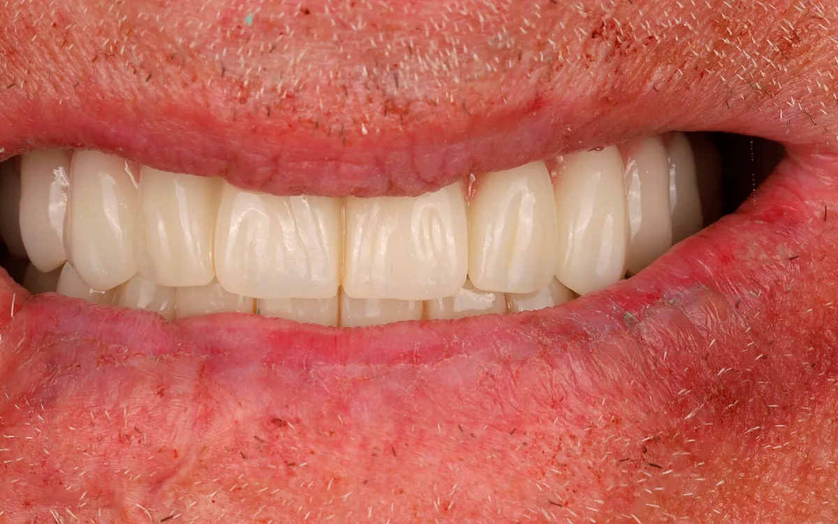 After: implant-supported restoration