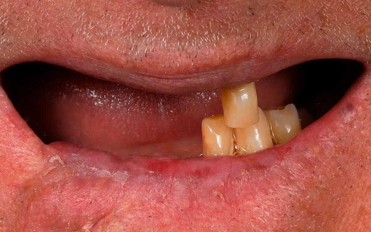 Before: missing upper teeth