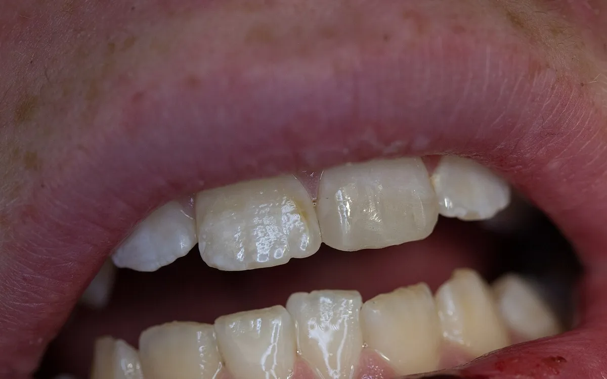 After: tooth rebuilt with bonded composite
