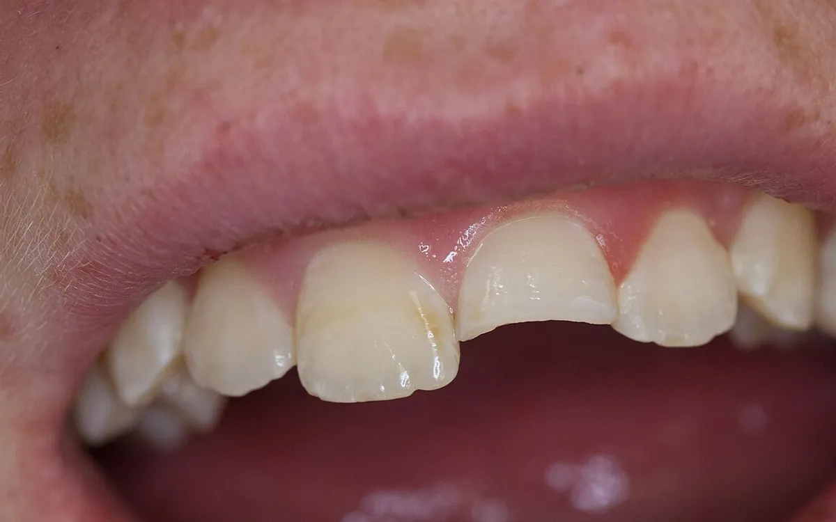 Before: fractured front tooth