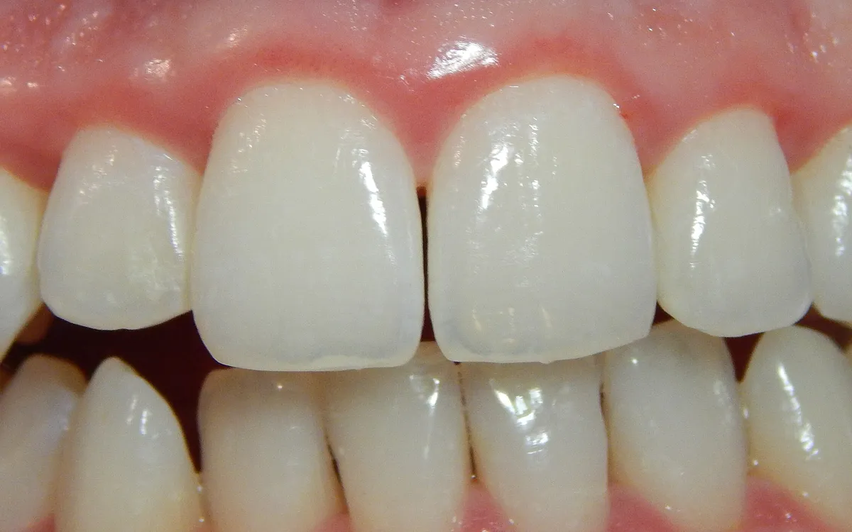 After: professional cleaning, healthier gums
