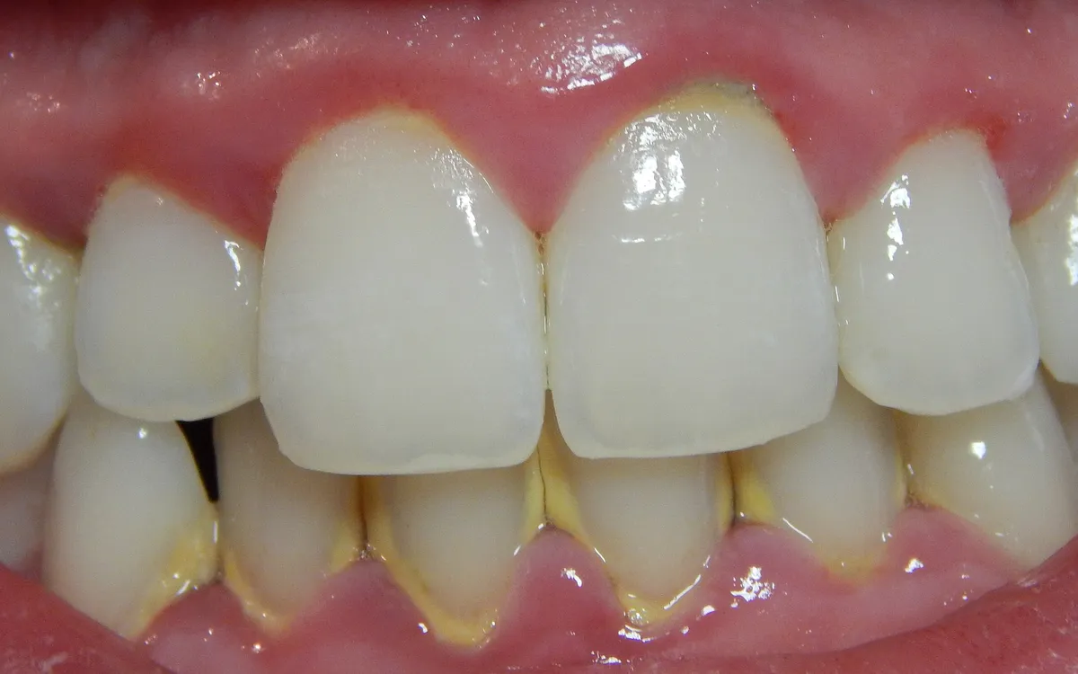 Before: tartar buildup and inflamed gums