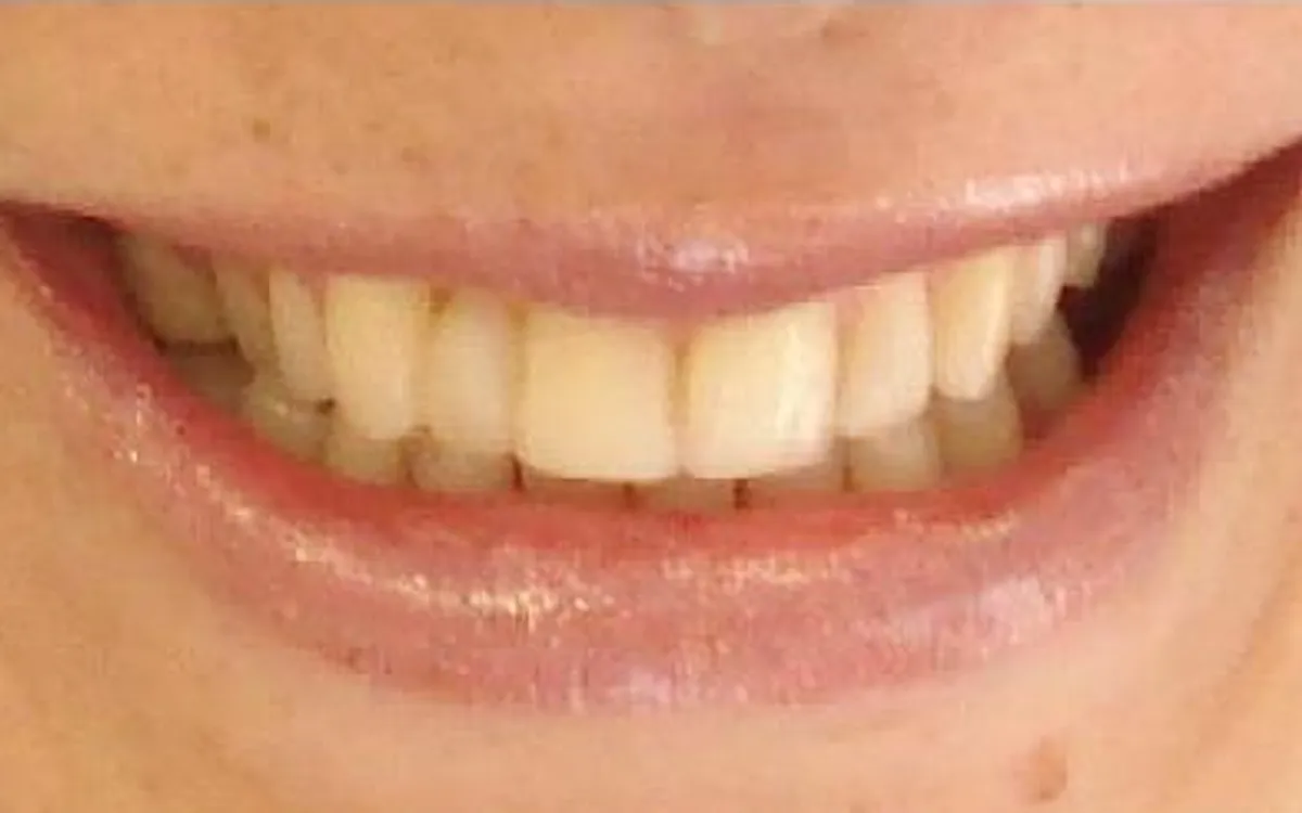 After: straightened, aligned smile