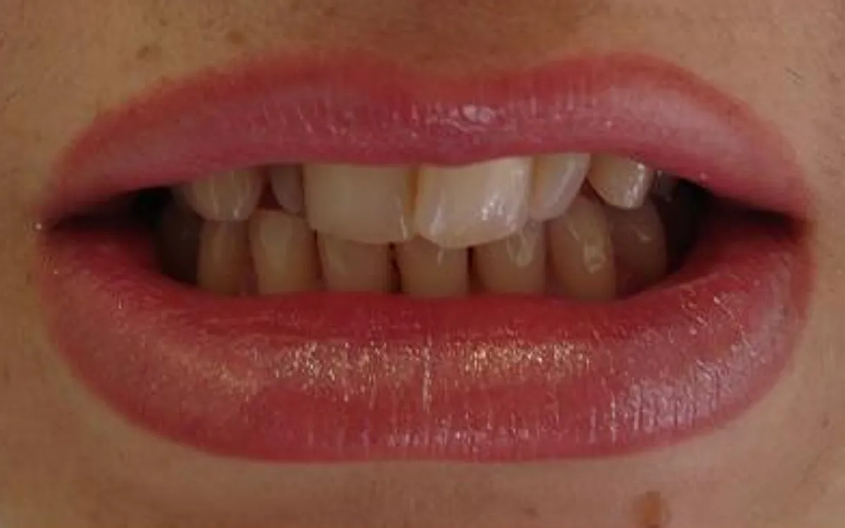 Before: crowded, overlapping teeth