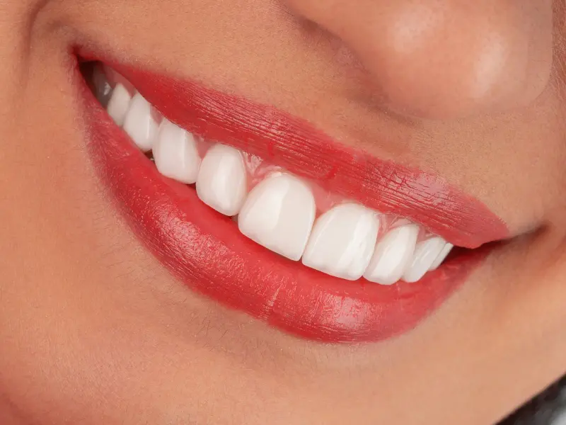 Close-up of a bright, natural-looking smile after cosmetic treatment